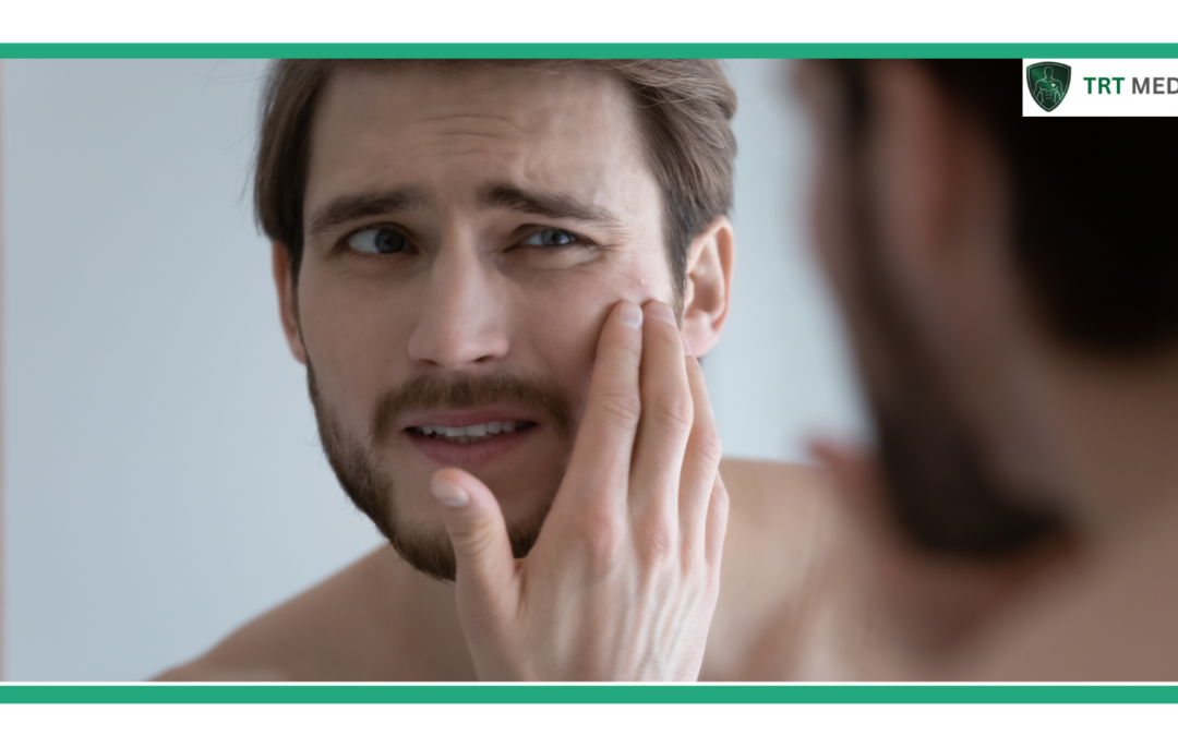 Does High Testosterone Cause Acne Breakouts?
